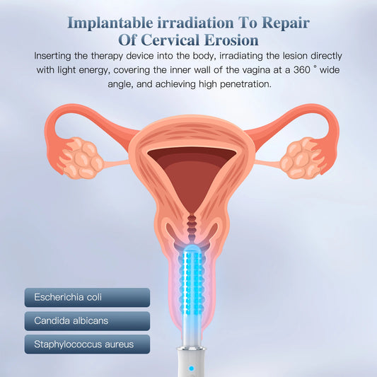 Red Light Therapy Device for Vaginitis Female